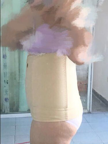 腰腹吸脂整形花了我两万多的钱  果真的挺不错的