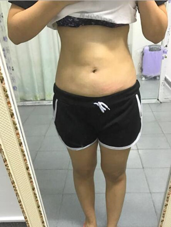 腰腹吸脂整形花了我两万多的钱  果真的挺不错的