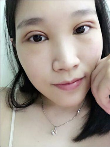 做全切双眼皮花了8000多 整体恢复果真的很棒