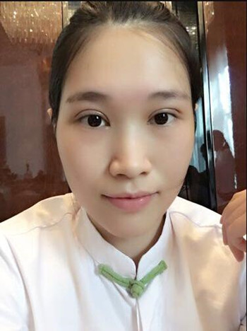 做全切双眼皮花了8000多 整体恢复果真的很棒