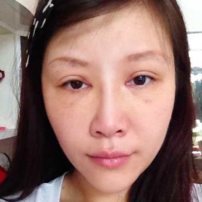 攀枝花奇丽王海沐切开双眼皮和硅胶隆鼻案例