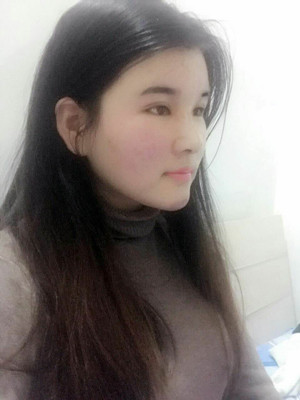 做了详细部脂肪填充+双眼皮+假体隆鼻，来看看果如何