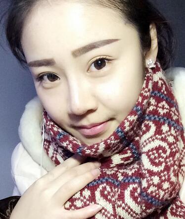 耳软骨垫鼻尖三个月图 耳软骨垫鼻尖+硅胶隆鼻