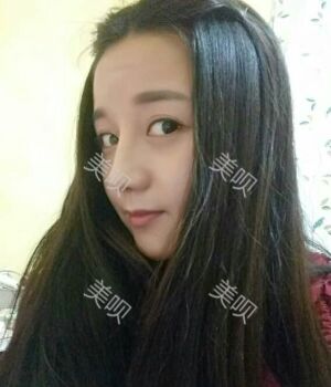 韩式隆鼻整形真实恢复期图片，自然不夸张