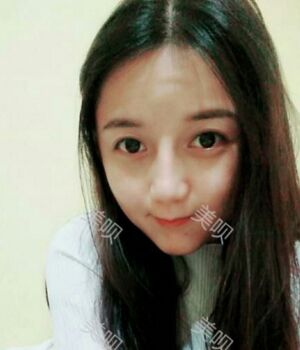 韩式隆鼻整形真实恢复期图片，自然不夸张