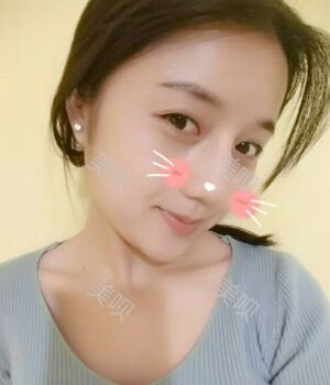 韩式隆鼻整形真实恢复期图片，自然不夸张