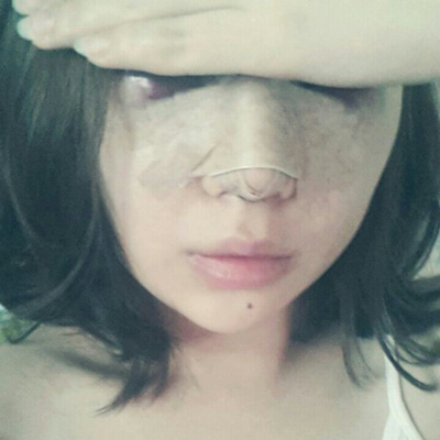 武汉五洲美莱周旭刚隆鼻整形案例