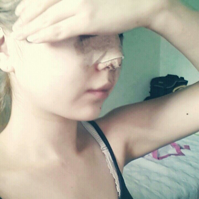 武汉五洲美莱周旭刚隆鼻整形案例