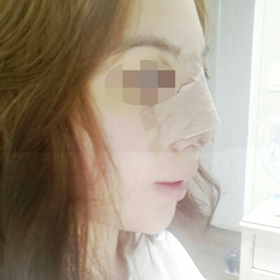 武汉五洲美莱周旭刚隆鼻整形案例