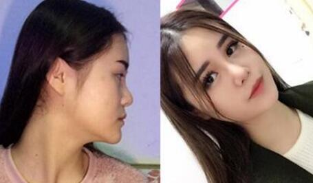 隆鼻前后对比图
