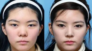 隆鼻的价格受到很多因素的影响