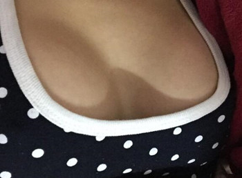 我的假体丰胸逆袭之路  亲身体验