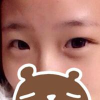 切开双眼皮消肿过程图，割双眼皮价格4980元，真实案例分享
