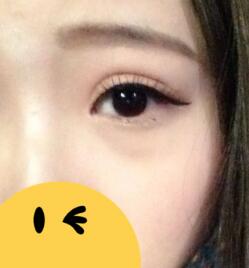 割双眼皮第10天