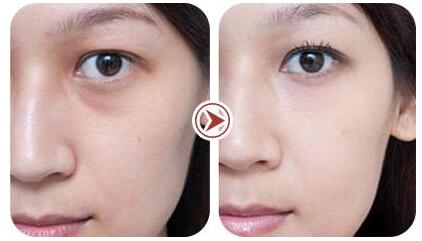 年轻人喜欢的去眼袋方法？超声波去眼袋是不二之选（去眼袋价格）