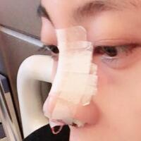 鼻子整形过程恢复图片，真实案例分享