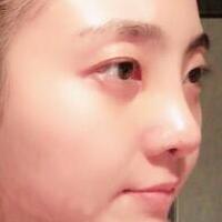 鼻子整形过程恢复图片，真实案例分享