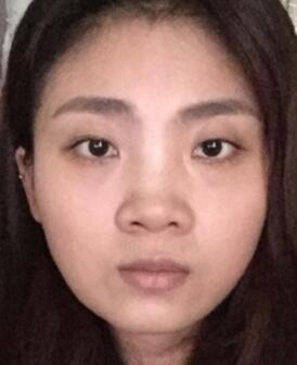 鼻子整形过程恢复图片，真实案例分享