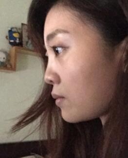 鼻子整形过程恢复图片，真实案例分享