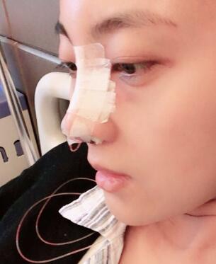 鼻子整形过程恢复图片，真实案例分享