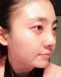 鼻子整形过程恢复图片，真实案例分享