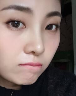 鼻子整形过程恢复图片，真实案例分享