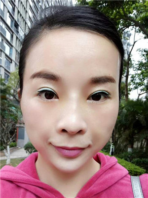 你们来看看我的面部埋埋蛋白线.提升术恢复情况