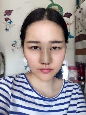 给你们分享隆鼻整形手术恢复过程