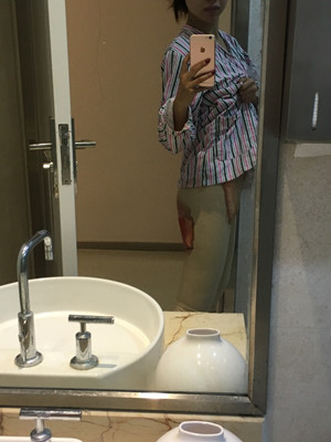 武汉同济冯幼平水动力吸脂瘦大腿前后对比照片~真实案例图分享