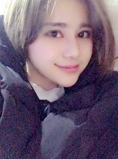 切开双眼皮+开眼角15天果图 双眼皮多项整形消肿过程