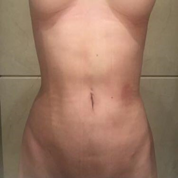 腹部环吸整形恢复果图  我的减肥逆袭史