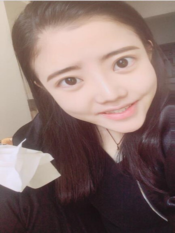我的隆鼻整形恢复果图  塌鼻子逆袭记
