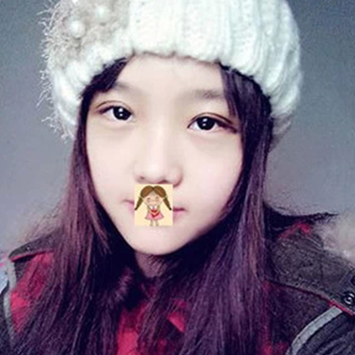 德阳金荣卢元刚埋线双眼皮案例