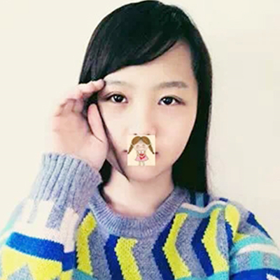 德阳金荣卢元刚埋线双眼皮案例