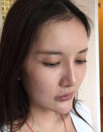 这是我做埋埋蛋白线.提升前拍的照片，看得出来面部肌肤走向下垂，皮肤松弛了