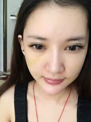 面部面b提升恢复日记和恢复图片，一周左右恢复自然