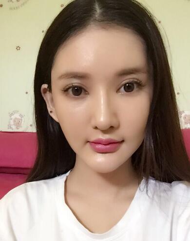 面部面b提升恢复日记和恢复图片，一周左右恢复自然