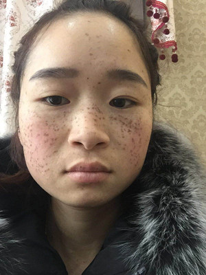 激光祛雀斑真实案例以及前后对比图分享——海口红妆李杰做的