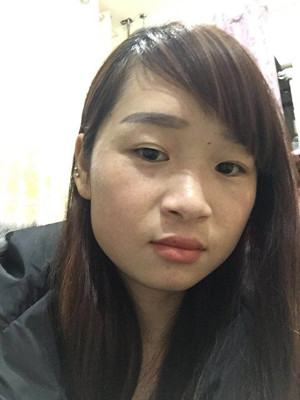 激光祛雀斑真实案例以及前后对比图分享——海口红妆李杰做的