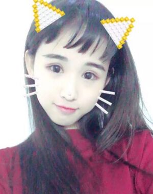 三点定位双眼皮恢复实例，张永义做的