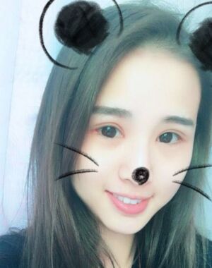 三点定位双眼皮恢复实例，张永义做的