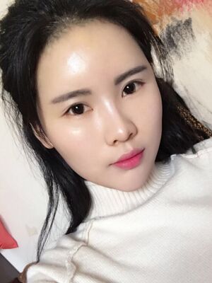 自体脂肪填充全脸经历，脸型超**的