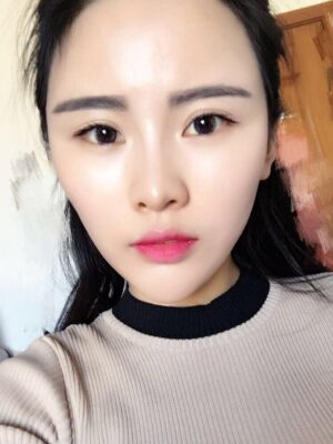 自体脂肪填充全脸经历，脸型超**的