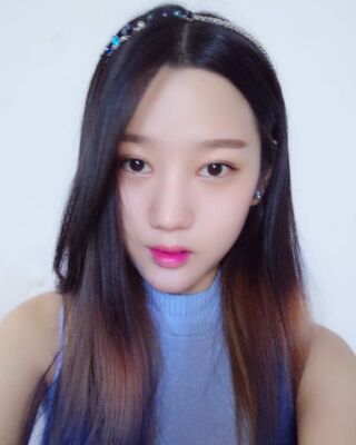 切开双眼皮+垫下巴前后对比照，无比自然