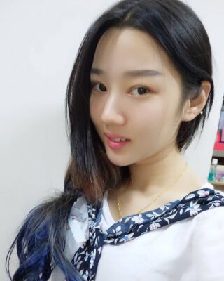 切开双眼皮+垫下巴前后对比照，无比自然