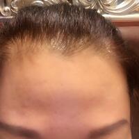 去抬头纹很好的方法是注射注射瘦脸，恢复过程图分享