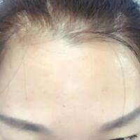 去抬头纹很好的方法是注射注射瘦脸，恢复过程图分享