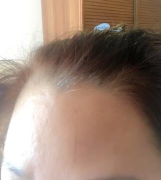 去抬头纹很好的方法是注射注射瘦脸