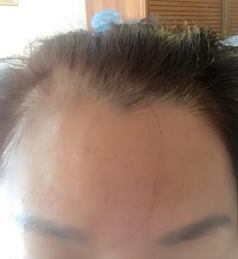 去抬头纹很好的方法是注射注射瘦脸