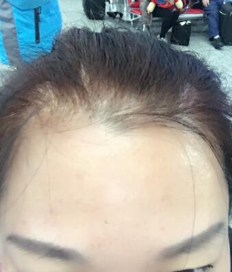 去抬头纹很好的方法是注射注射瘦脸